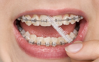 interdental brushes for braces