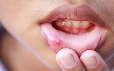 cold sores on lips early stages