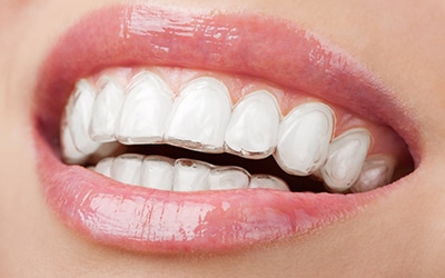 Mouth with retainer