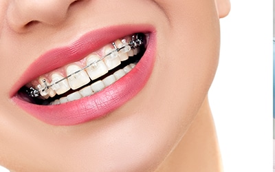 Woman smiling with braces